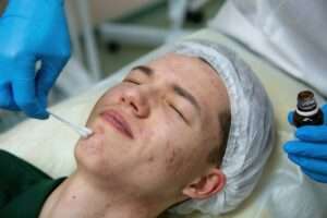 Acne treatment in a teenager.