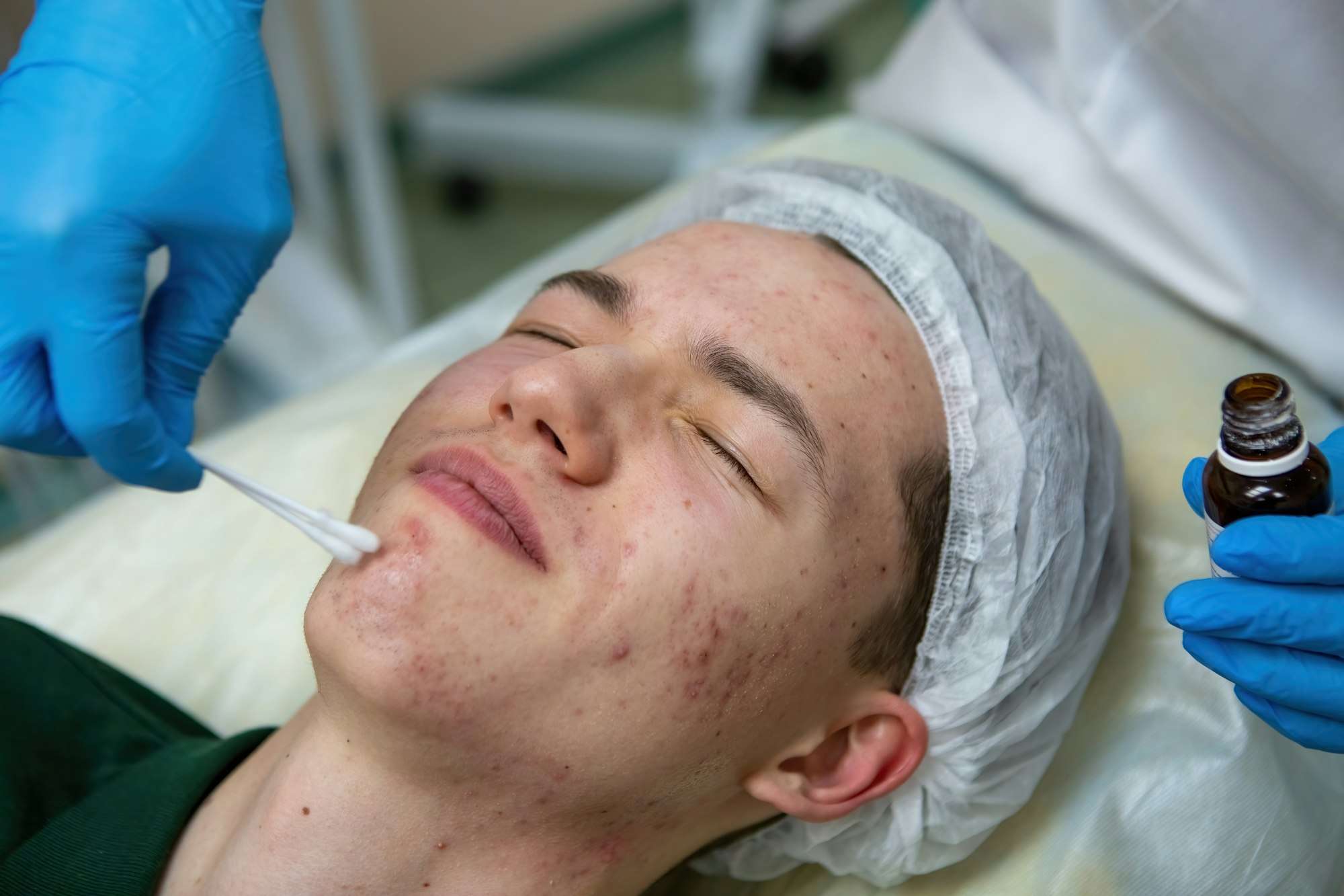 Acne treatment in a teenager.