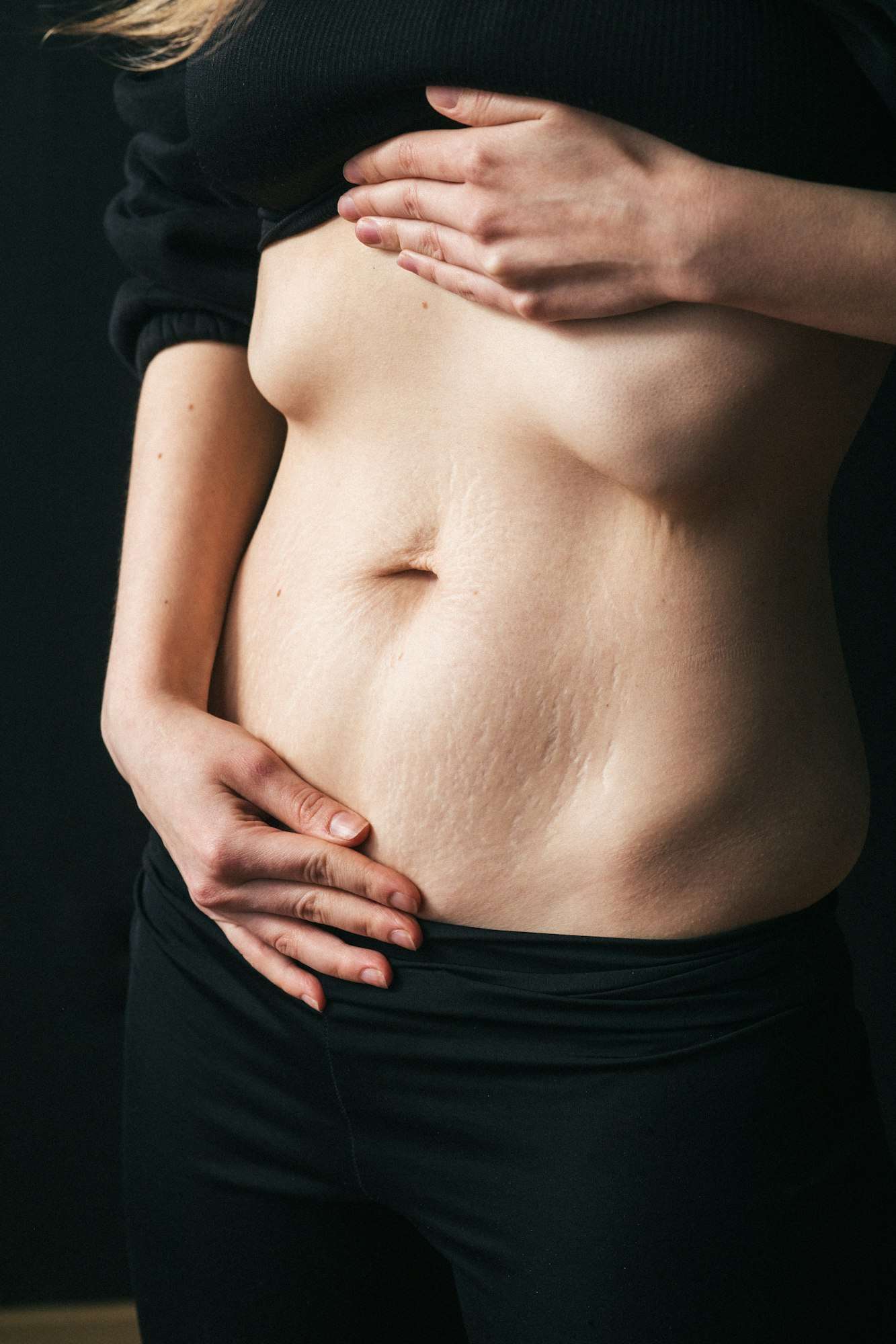 Close-up of female showing stretch marks. Women body after childbirth. Body recovery and care.